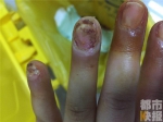 做美甲女子指头发紫流液体 患脓性指头炎拔甲治疗 - 中国在线