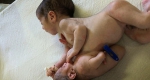 印母亲产下罕见寄生双胞胎 手术后仅一人幸存 - 西安网