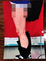 女生被同桌用笔扎得满腿是伤 校方:同学间开玩笑 - 西安网