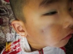 3岁男童被高空坠棍当场砸晕 脸部现5厘米淤青 - 西安网