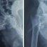 术前X光片显示骨折移位明显 - 陕西新闻