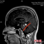 年少时生吃活青蛙 长沙男子颅内长寄生虫 - 西安网