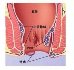 上海医博肛泰医院：内痔出血、疼痛怎么办？ - 西安网